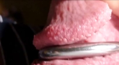 Pearly Penile Papules